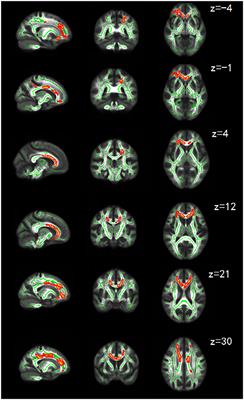 Cerebral White Matter Changes in Young Healthy Individuals With High Trait Anxiety: A Tract-Based Spatial Statistics Study